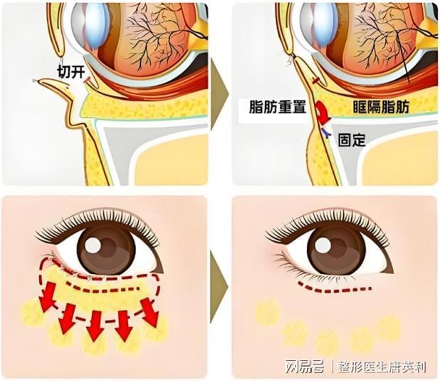 ：什么是眶隔释放——科普篇k8凯发入口整形医生唐英利(图2)